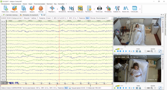 Система видеонаблюдения при длительной регистрации ЭЭГ Нейрон-Спектр-Видео